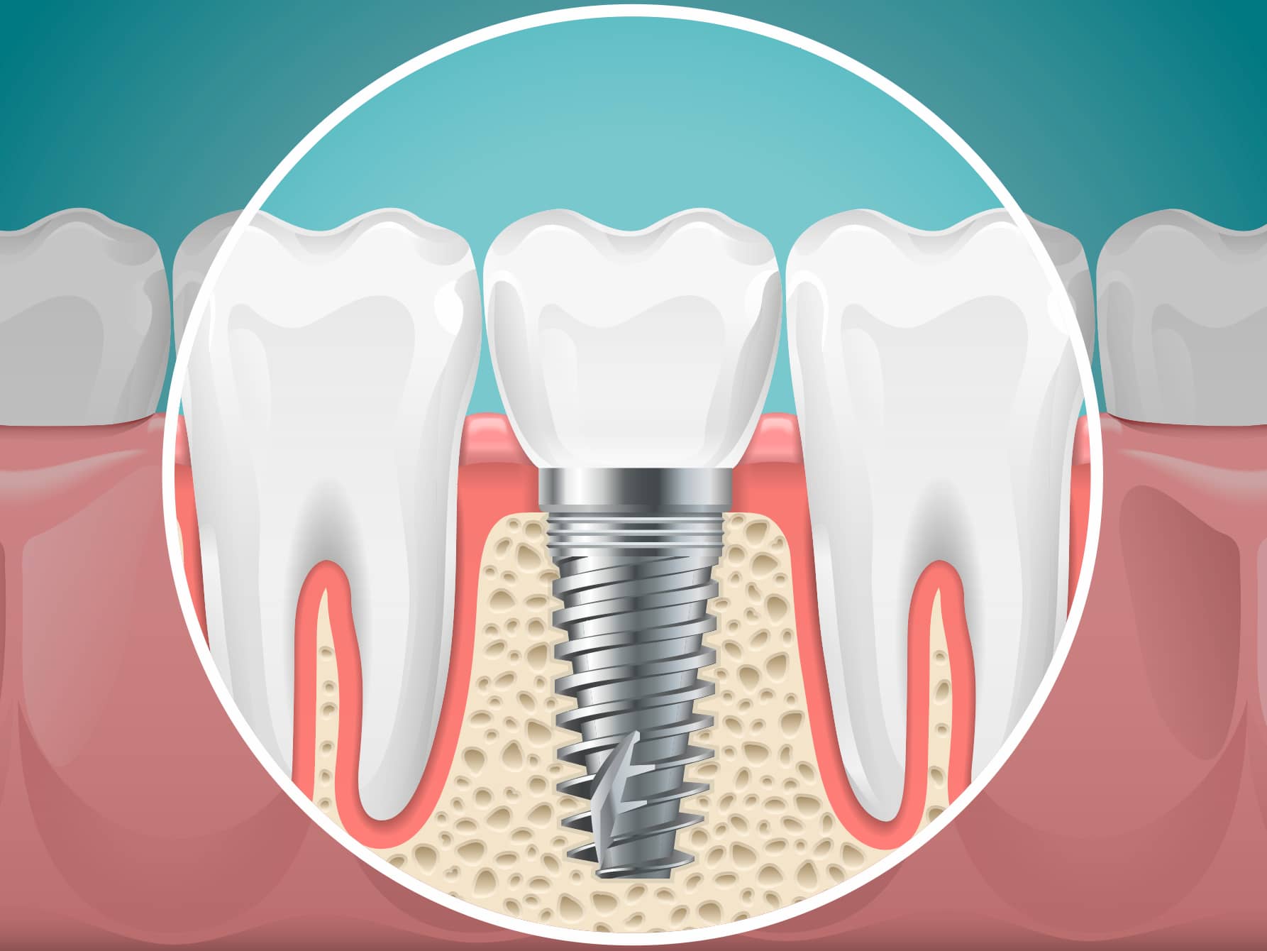 Schéma d'un implant dentaire